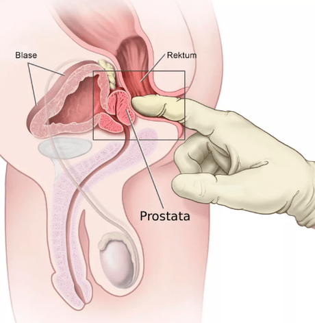 Prostaatmassage